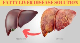 fatty liver diet