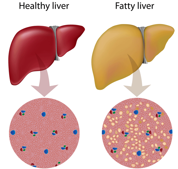 fatty-liver-illustration