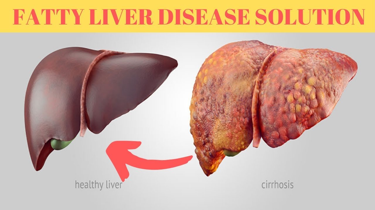 fatty liver