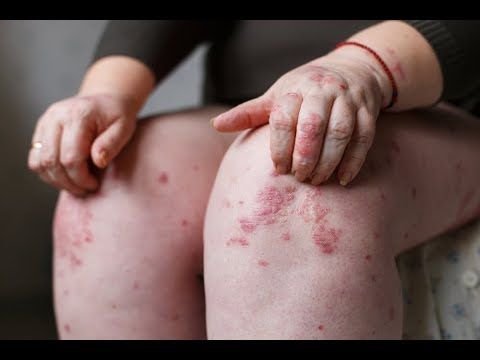 psoriasis treatment home remedies