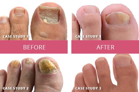FUNGAL INFECTION OF FEET
