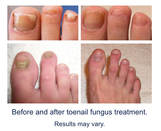 fungal infection home remedy